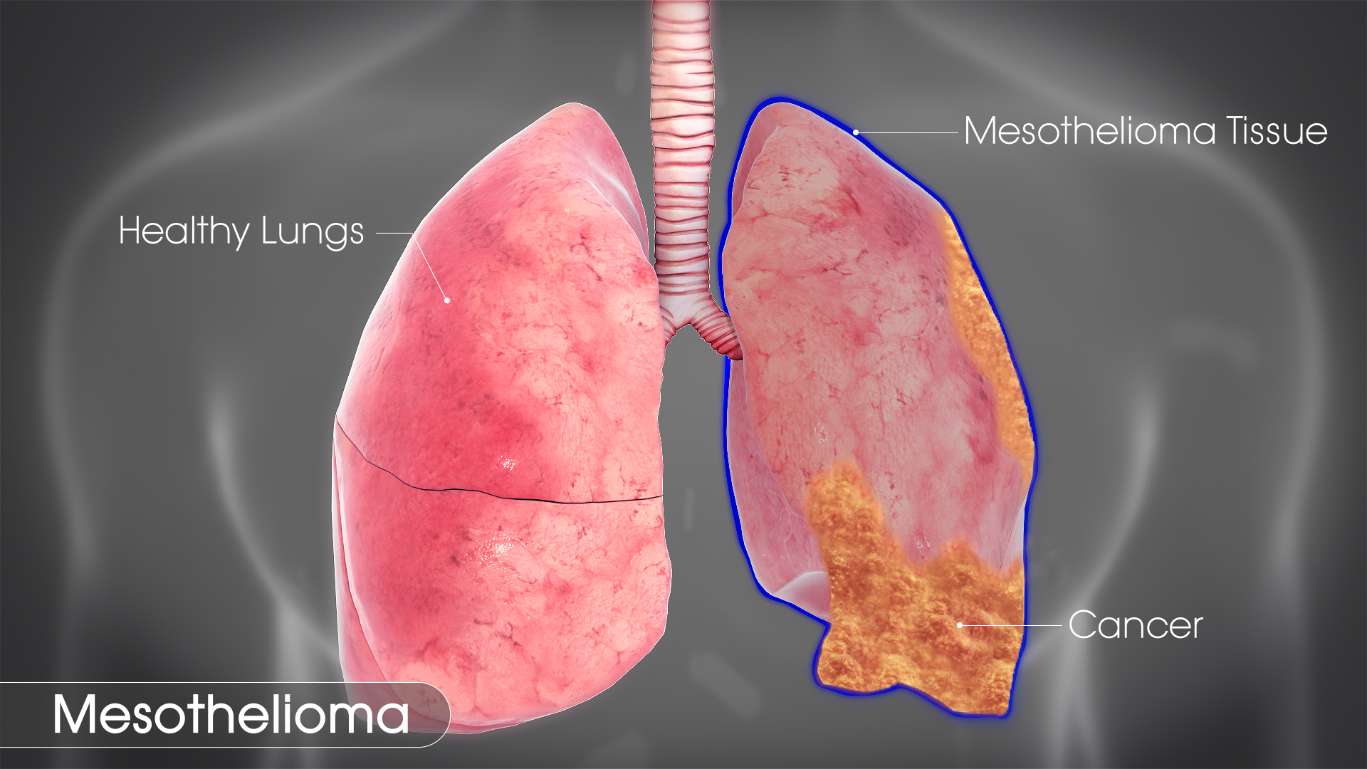 Mesothelioma Lawyer In Washington